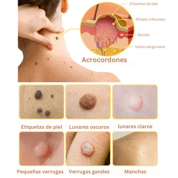 Tag Recede Eliminador de Verrugas