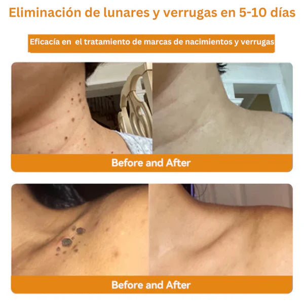 Tag Recede Eliminador de Verrugas